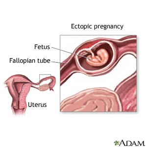 Ectopic Pregnancy